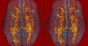 Balıq insulta səbəb ola bilərmi?