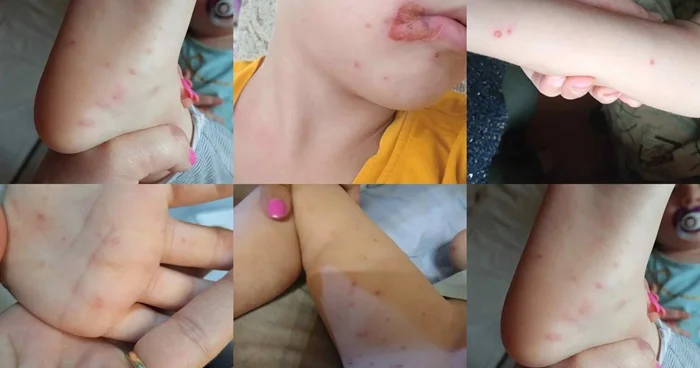Uşağınızda koksaki varsa, bunları edin Həkimdən xəbərdarlıq