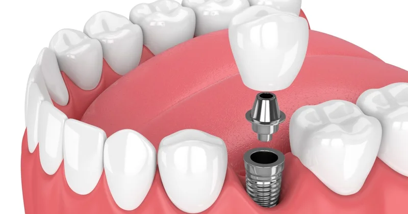 Diş və dişsizlik: implant çarədirmi?