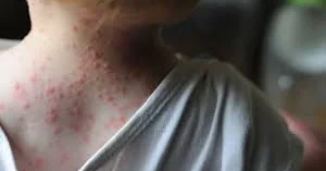 Azərbaycanda suçiçəyinə rekord yoluxma