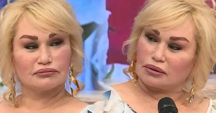 Plastik əməliyyat etdirən Sevdanın üzü əyildi Video