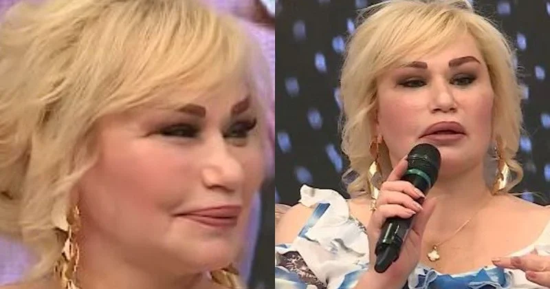 Daha bir müğənninin əməliyyatdan sonra üzü əyildi
