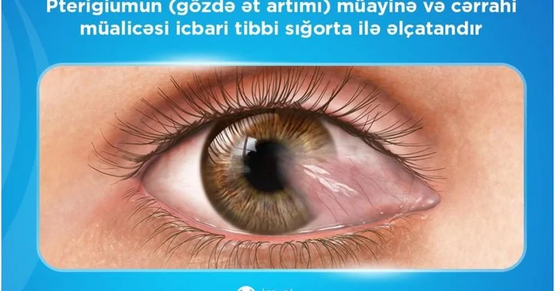 Ötən il icbari tibbi sığorta ilə gözdə ət artığının götürülməsi üçün 2192 əməliyyat edilib