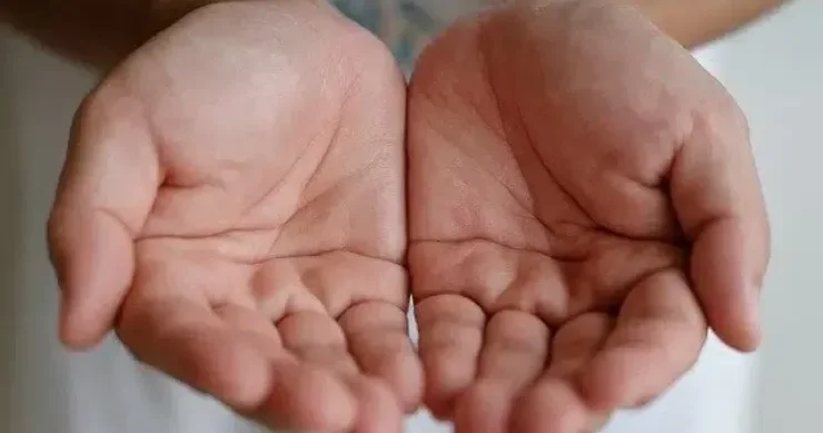 Əl və dırnaqlarda görünən dəyişikliklər hansı xəstəlikdən xəbər verir?
