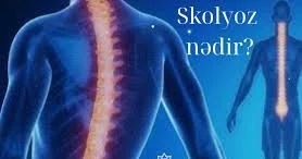 Skalioz niyə yaranır? HƏKİM DANIŞDI
