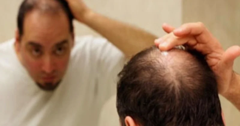 Kişilərin saçı yaş artdıqca niyə tökülür? Əsas səbəb nədir?