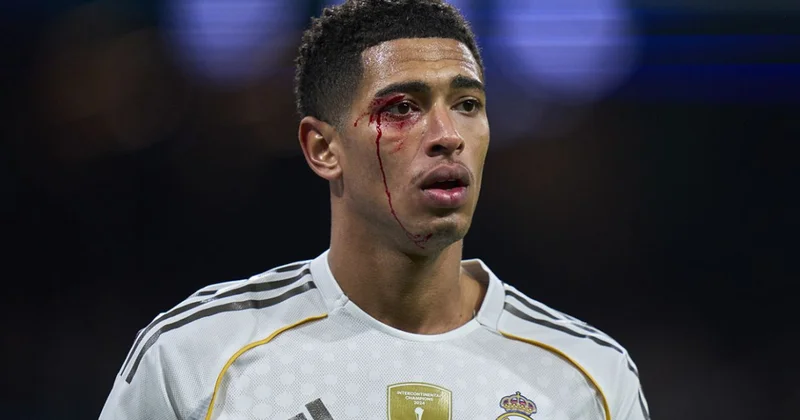 Jud Bellingemin qaşı partlasa da oyunu davam etdirib