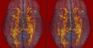 Balıq insulta səbəb ola bilərmi?