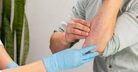 Psoriaz və göbələyin yeni müalicəsi tapıldı