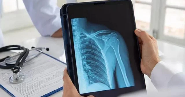 50 yaşdan yuxarı qadınlar osteoporozdan daha çox əziyyət çəkirlər...
