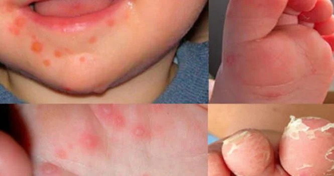 Koksaki virusu kabus kimi geri döndü Pediatrdan AÇIQLAMA