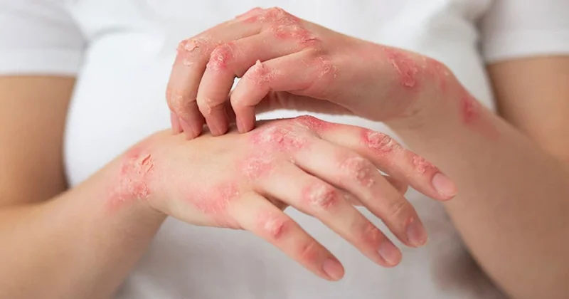 Dəri problemlərinin arxasında nə dayanır? Yüksəkdozalı Vitamin C ilə antioksidant müdafiəyə dəstək