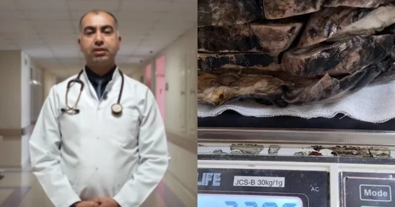 Türkiyədə xəstə nəfəs darlığı şikayəti ilə həkimə getdi: Sinəsindən çıxan üç kiloqramlıq kütlə təəccübləndirdi