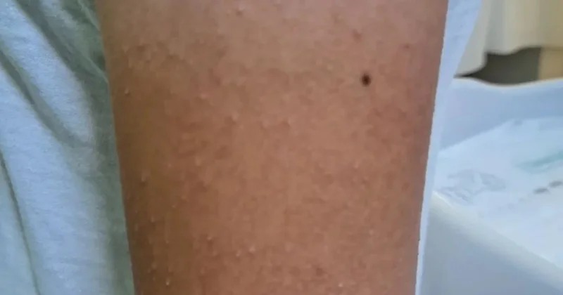 Uşağın dərisində bu cür səpkilər varsa... Pediatrdan xəbərdarlıq