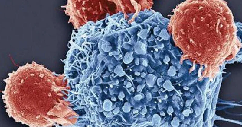 Alimlər xərçəngin ən ölümcül növlərindən birinə səbəb olan vərdişi açıqlayıb