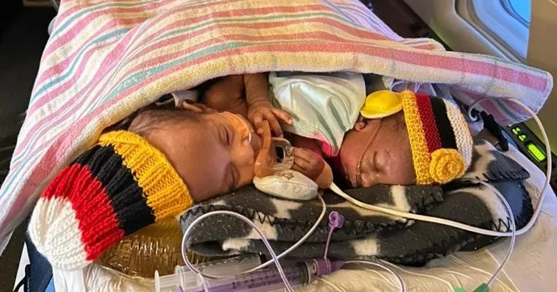 Avstraliyada siam əkizləri üzərində mürəkkəb əməliyyat: Körpələrdən biri sağ qaldı