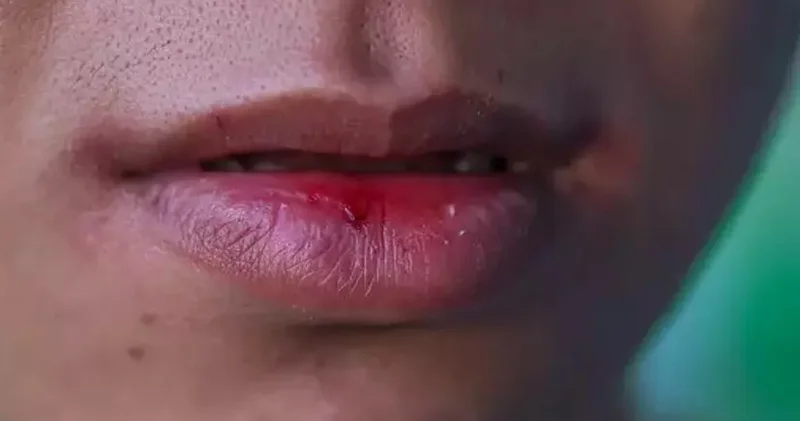 Əlləriniz və dodaqlarınız daim çatlayır? Səbəb düşündüyünüzdən fərqli ola bilər