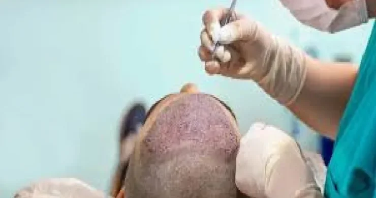 47 yaşlı kişi saç əkimi zamanı öldü