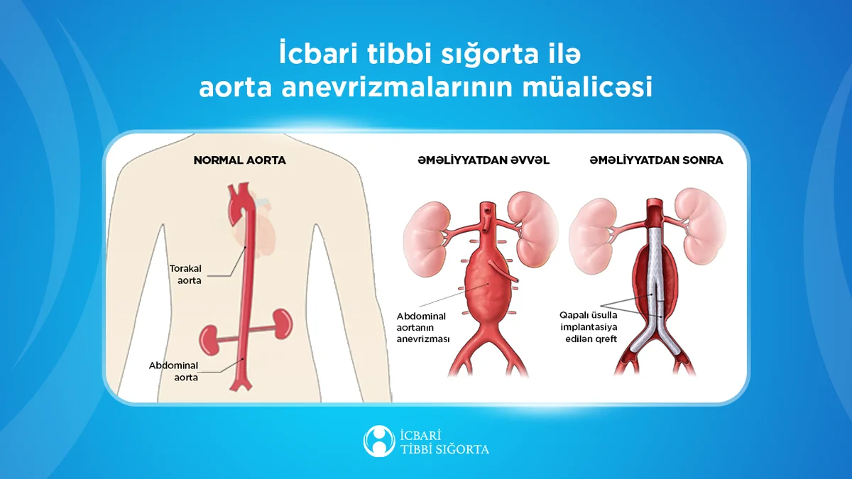 Aortanın protezləşdirilməsi nəticəsində 256 nəfər qəfil ölümdən xilas olub