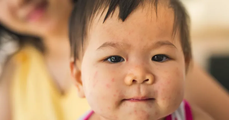 В Казахстане родители все чаще отказываются вакцинировать детей от кори