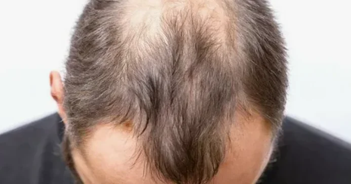 Keçəlliyin əlacı tapıldı