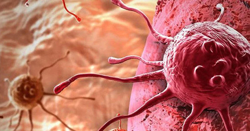 Bu yaşda insanlarda bağırsaq xərçəngi yayılır ƏLAMƏTLƏR