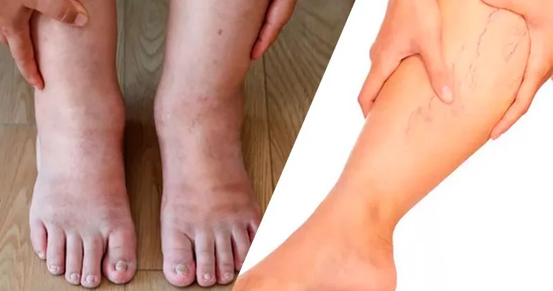 Axşama doğru ayaqlar şişir və ağırlaşır?