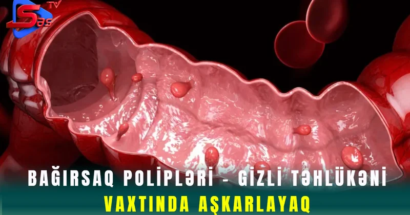 Bağırsaq Polipləri Gizli Təhlükəni Vaxtında Aşkarlayaq