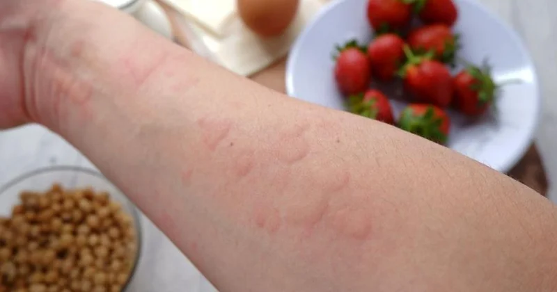 Allergen həssaslığı olan şəxslər üçün çarpaz çirklənmə ciddi riskdir Qida eksperti