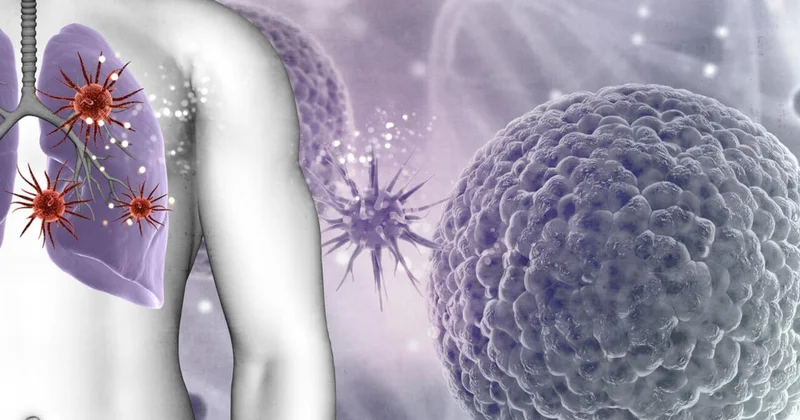 Alimlər ağciyər xərçənginin inkişaf səbəbini tapdı