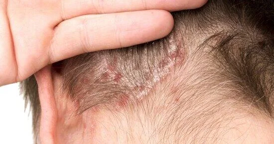 Başdakı sızanaqlar bu problemlərdən xəbər verə bilər