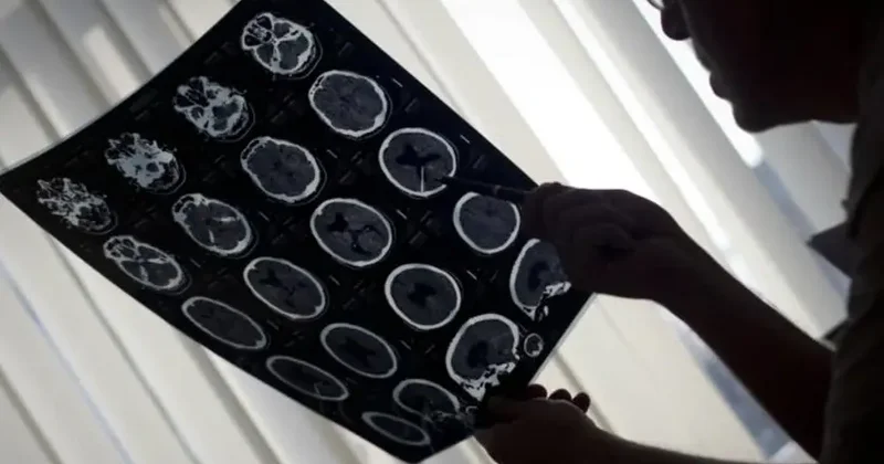 İnsultun fəsadları əleyhinə ultrasəs terapiyası yaradılıb