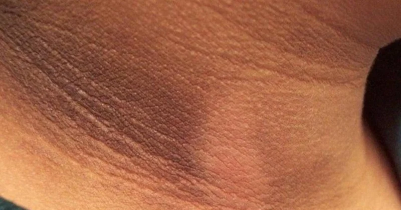 Dibaetin erkən əlamətləri Dəridə belə izlər yaranır