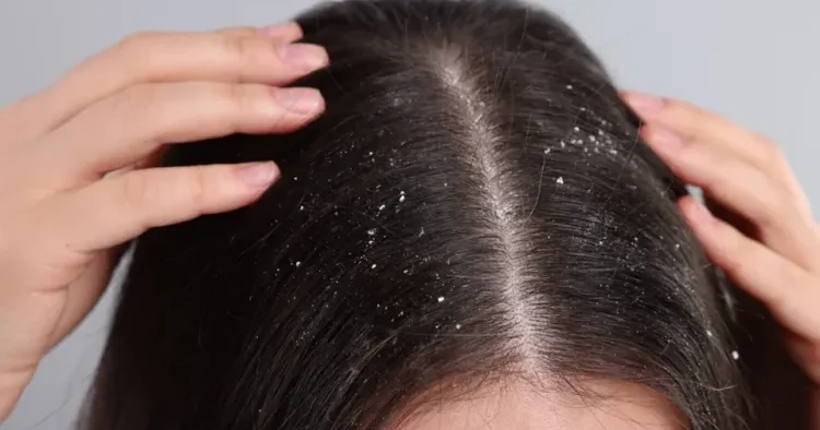 Saçdakı kəpəkdən qurtulmağın ÜSULLARI