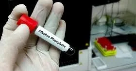 Ümumi qan analizi gizli sümük xəstəliyini göstərir