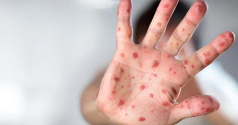 Avropa və Mərkəzi Asiyada qızılca halları 75 faiz azalıb, amma ÜST və UNICEF davam edən təhlükə barədə xəbərdarlıq edir