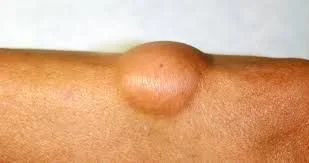 Lipoma jirovik nədir və niyə yaranır?