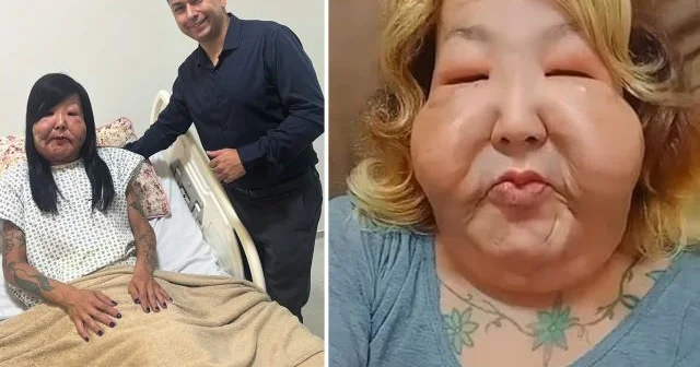 Gözəllik naminə üzü tanınmaz hala gəldi FOTO