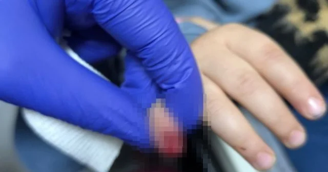 3 yaşlı uşağın əli eskalatorda qaldı Barmağı kəsildi