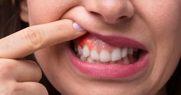 Diş ətiniz qanayırsa, bu vitamin çatışmır