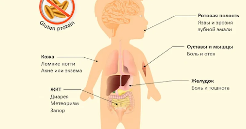 В Азербайджане лечат редкое заболевание кишечника