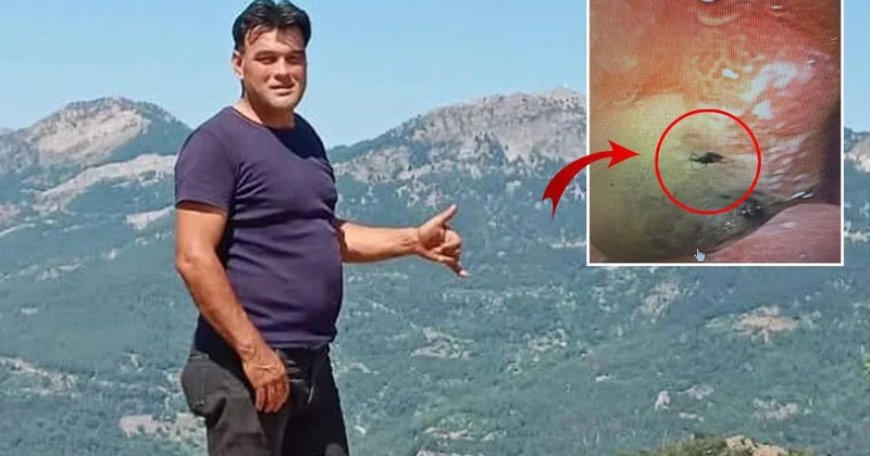 Kabus kimi bir hadisə Mədəsindən canlı həşərat çıxarıldı