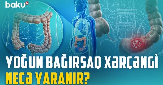 Yoğun bağırsaq xərçənginin qarşısını necə almaq olar?