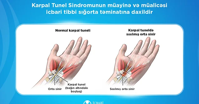 Karpal Tunel Sindromunun müalicəsi də icbari tibbi sığorta təminatına daxildir