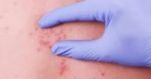 Bədəninizdə parazit olub olmadığını evdə necə bilməli?