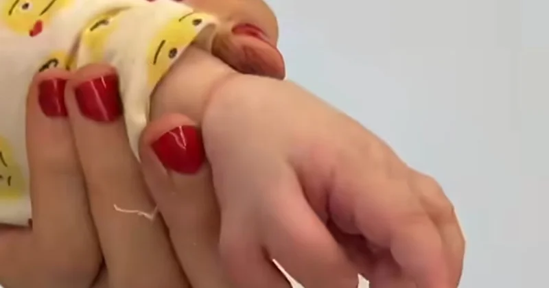 Əldə artıq barmaq nədəndir? Həkim açıqladı