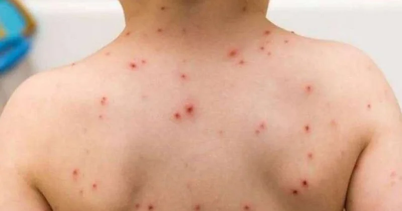 Azərbaycanda qızılca epidemyası ilə bağlı rəsmiAÇIQLAMA