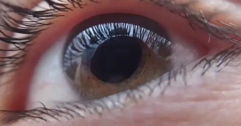 Vitamin əlavələri optik sinirin zədələnməsini yavaşlada bilər TƏDQİQAT