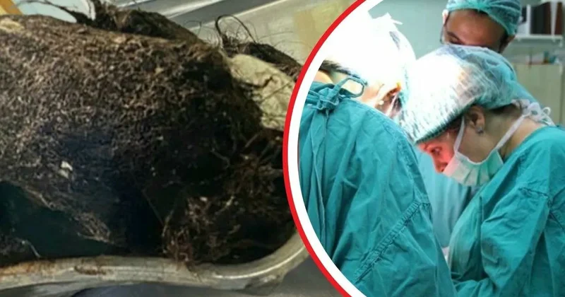 14 yaşlı qız qarın ağrısı ilə həkimə müraciət etdi Mədəsindən çıxanlar həkimləri şoka saldı