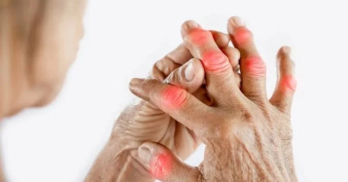 Revmatoid artritlə yaşayanlar nələrə diqqət etməlidir? SN nin revmatoloqundan tövsiyələr
